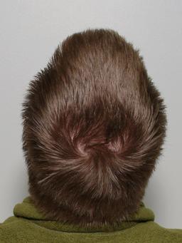 Implantation des cheveux sur le crâne. Source : http://data.abuledu.org/URI/532ed057-implantation-des-cheveux-sur-le-crane